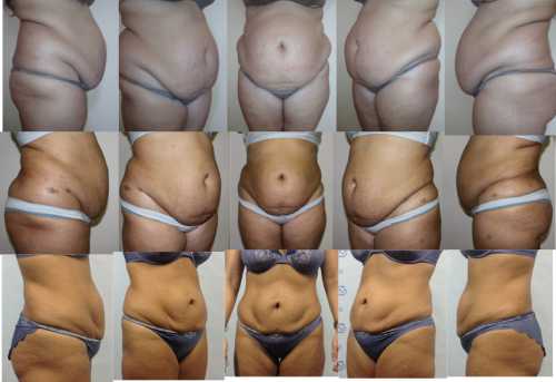 Полная абдомино пластика длится дольше других видов операции и более рискованна в смысле возникновения осложнений