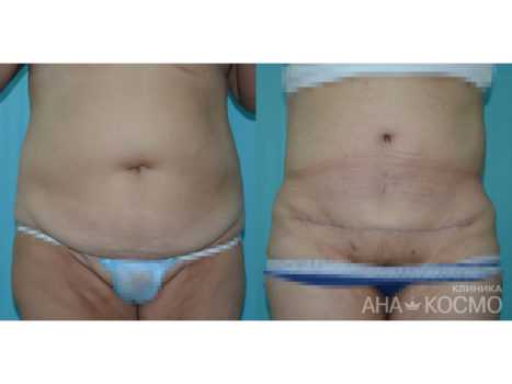 Как проводится абдоминопластика