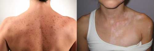 Что делать, если после загара появились пигментные пятна: правила и советы