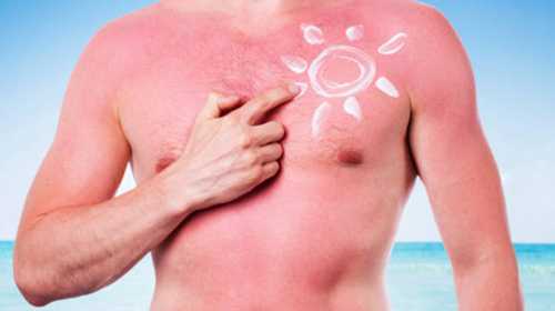 Cолнечный ожог: лечение и профилактика