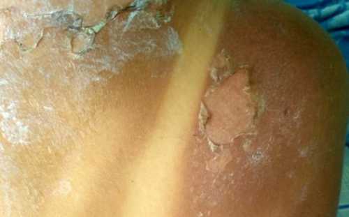 Лечение химических ожогов