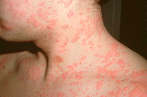 Чтобы снять кожные проявления пищевой аллергии, народная медицина советует пользоваться ваннами из ромашки