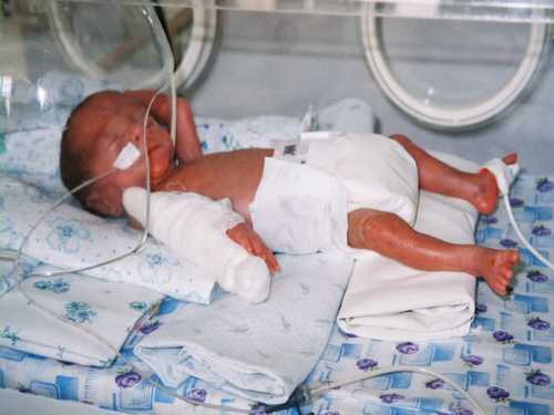 Мышечный тонус у недоношенных детей слабый, физиологические рефлексы и двигательная активность снижены, реакция на раздражители замедлена, терморегуляция нарушена, имеется склонность как к гипо, так и гипертермии