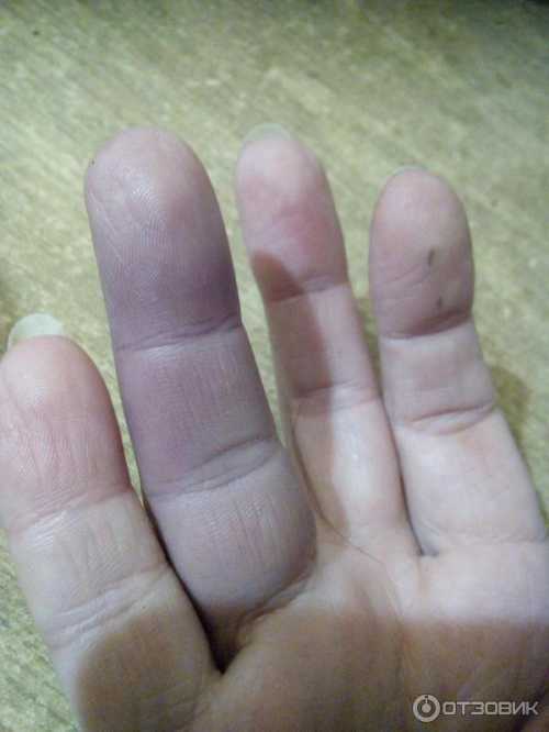 Важно своевременно выявить причину повышенной ломкости капилляров, ведь эта патология нередко может обернуться такими осложнениями как инсульт, внутреннее кровотечение и др