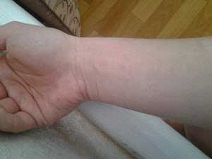 Если лопнул сосуд на пальце