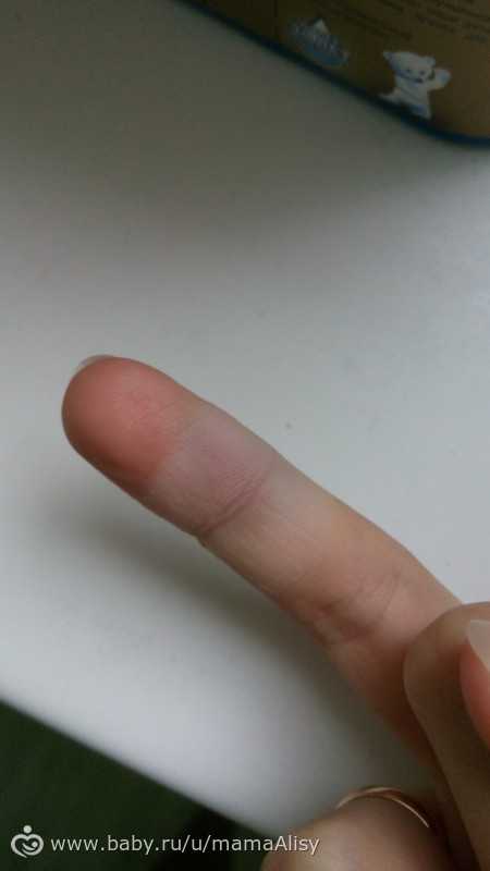 Изменение формы капилляров и нарушение их целостности свидетельствуют о проблеме