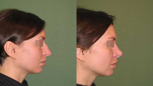 Совет врача: как решить проблему горбинки на носу