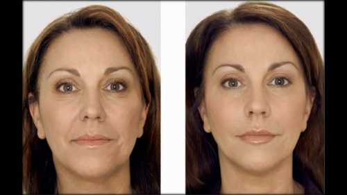 Выраженный разгла живающий эффект наступит уже после первой процедуры