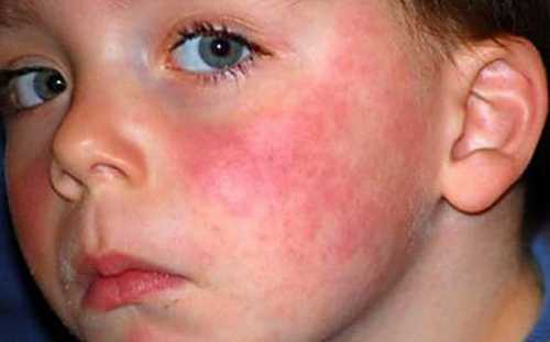 Иногда фотодерматит проявляется ввиде крапивницы