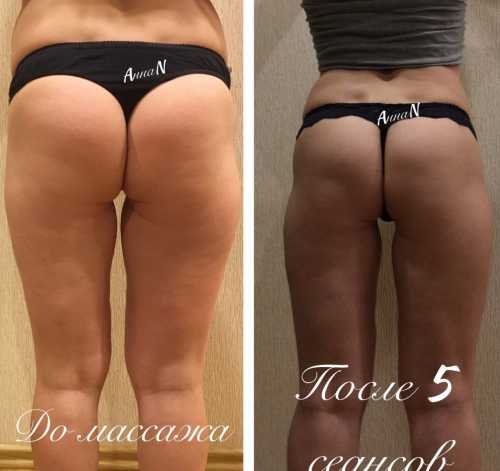 Как избавиться от целлюлита