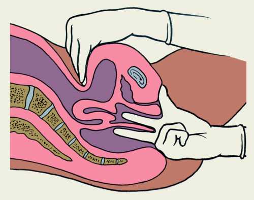 При недоступности оттока скопившегося гноя диагностируют эмпиему