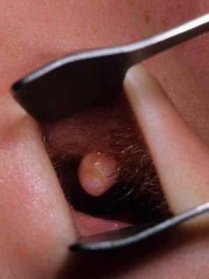 Такое заболевание требует немедленного лечения